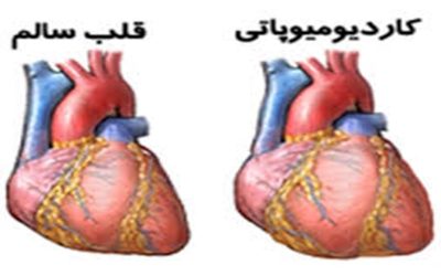 نارسایی قلبی و کاردیومیوپاتی
