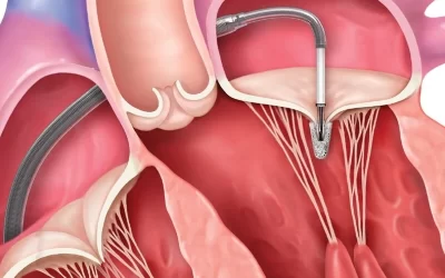 افتادگی دریچه میترال